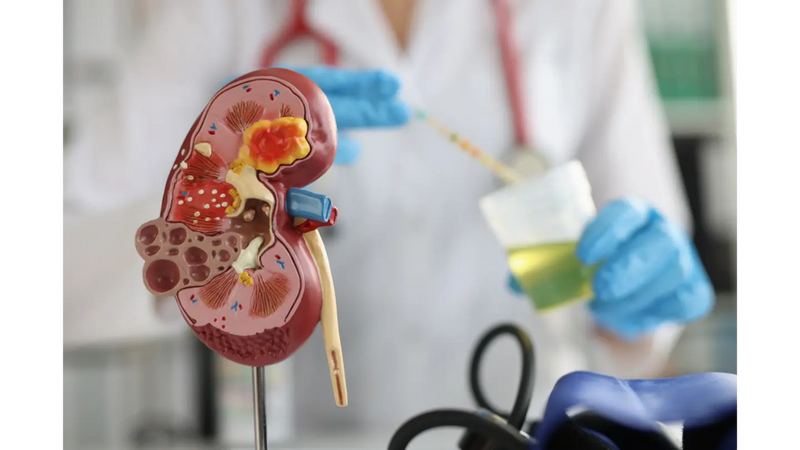Understanding Proteinuria: Why Identifying the Cause is Key to Effective Treatment