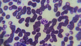 Ketones in Urine