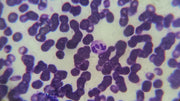 Ketones in Urine