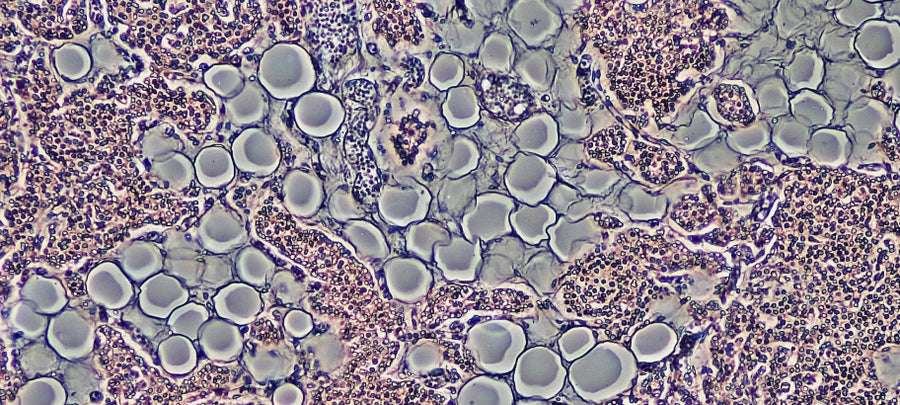 Bacterial Vaginosis (BV)
