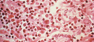 Yeast Infections