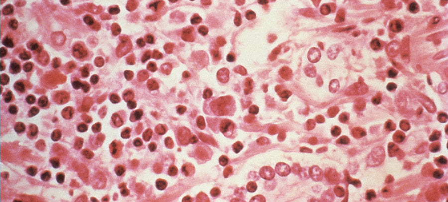 Yeast Infections
